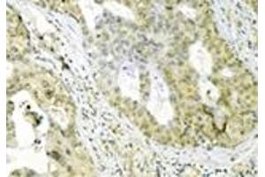 Immunohistochemistry analysis of human breast cancer tissue immunohistochemically stained using Grp75 mAb (30A5). (HSPA9 anticorps)