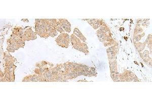 Immunohistochemistry of paraffin-embedded Human liver cancer tissue using PSMA4 Polyclonal Antibody at dilution of 1:50(x200) (PSMA4 anticorps)