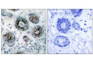 Immunohistochemical analysis of paraffin-embedded human breast carcinoma tissue, using GAP43 (Ab-41) antibody (E021273). (GAP43 anticorps)