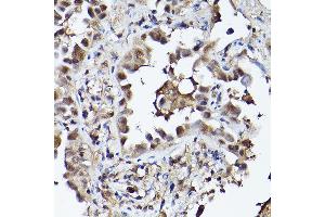 Immunohistochemistry of paraffin-embedded human lung cancer using PHD3 Rabbit pAb (ABIN6130355, ABIN6139990, ABIN6139991 and ABIN6224021) at dilution of 1:150 (40x lens). (EGLN3 anticorps  (AA 1-120))