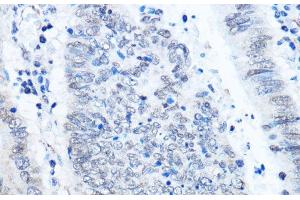 Immunohistochemistry of paraffin-embedded Human colon carcinoma using ADAR Polyclonal Antibody at dilution of 1:100 (40x lens). (ADAR anticorps)
