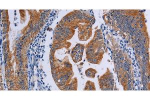 Immunohistochemistry of paraffin-embedded Human gasrtic cancer tissue using ACP6 Polyclonal Antibody at dilution 1:50