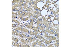 Immunohistochemistry of paraffin-embedded human liver injury using HYAL1 antibody (ABIN5975045) at dilution of 1/100 (40x lens). (HYAL1 anticorps)