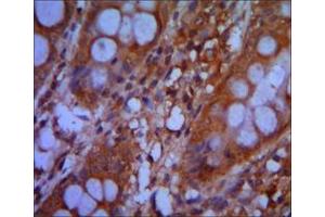 Immunohistochemical analysis of paraffin-embedded colon cancer tissues using CHD3 mouse mAb with DAB staining.