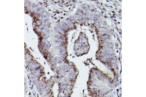 Immunohistochemistry of paraffin-embedded human colon carcinoma using GOLGB1 Rabbit pAb (ABIN7267498) at dilution of 1:100 (40x lens). (Golgin B1 (GOLGB1) anticorps)