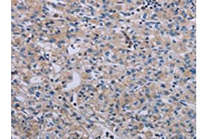 The image on the left is immunohistochemistry of paraffin-embedded Human prostate cancer tissue using ABIN7191769(PAGE4 Antibody) at dilution 1/40, on the right is treated with synthetic peptide. (PAGE4 anticorps)