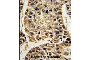 Formalin-fixed and paraffin-embedded human hepatocarcinoma reacted with SERPINA4 Antibody (C-term), which was peroxidase-conjugated to the secondary antibody, followed by DAB staining. (SERPINA4 anticorps  (C-Term))