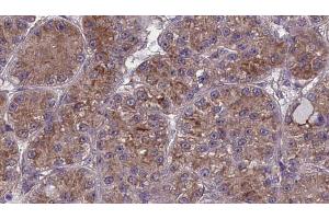 ABIN6273986 at 1/100 staining Human liver cancer tissue by IHC-P. (OR2W1 anticorps  (C-Term))
