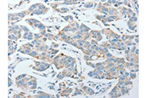 The image on the left is immunohistochemistry of paraffin-embedded Human lung cancer tissue using ABIN7128282(AGA Antibody) at dilution 1/20, on the right is treated with fusion protein.