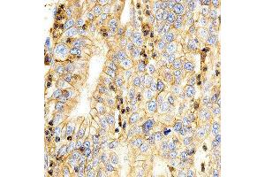 Immunohistochemistry of paraffin-embedded human stomach cancer using BSG antibody at dilution of 1:200 (x400 lens).