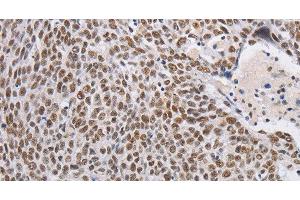 Immunohistochemistry of paraffin-embedded Human lung cancer using THOC7 Polyclonal Antibody at dilution of 1:30 (THOC7 anticorps)