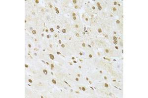 Immunohistochemistry of paraffin-embedded human liver injury using ANP32A Antibody.