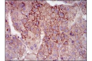 Immunohistochemical analysis of paraffin-embedded liver cancer tissues using MELK mouse mAb with DAB staining. (MELK anticorps  (AA 637-651))