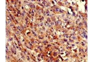 Immunohistochemistry of paraffin-embedded human melanoma using ABIN7145071 at dilution of 1:100 (COQ8B anticorps  (AA 10-137))