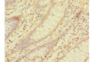 Immunohistochemistry of paraffin-embedded human colon cancer using ABIN7158359 at dilution of 1:100