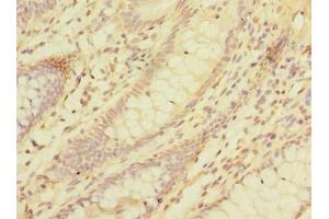 Immunohistochemistry of paraffin-embedded human colon cancer using ABIN7158359 at dilution of 1:100 (LMO3 anticorps  (AA 1-145))