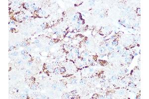 Immunohistochemistry of paraffin-embedded human liver cancer using Cathepsin L/V/K/H Rabbit mAb (ABIN7266150) at dilution of 1:100 (40x lens).