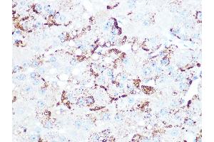 Immunohistochemistry of paraffin-embedded human liver cancer using Cathepsin L/V/K/H Rabbit mAb (ABIN7266150) at dilution of 1:100 (40x lens). (Cathepsin L anticorps)