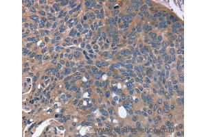 Immunohistochemistry of Human esophagus cancer using RGS4 Polyclonal Antibody at dilution of 1:30