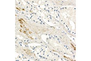 Immunohistochemistry of paraffin-embedded human prostate cancer using MMP7 Rabbit mAb (ABIN7268425) at dilution of 1:150 (40x lens). (MMP7 anticorps)