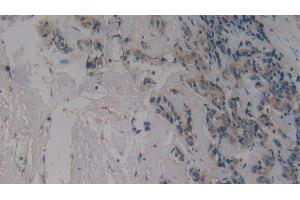 Detection of GYPA in Human Breast cancer Tissue using Polyclonal Antibody to Glycophorin A (GYPA) (CD235a/GYPA anticorps  (AA 20-91))