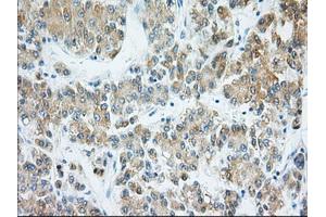 Immunohistochemical staining of paraffin-embedded Adenocarcinoma of Human ovary tissue using anti-H6PD mouse monoclonal antibody. (Glucose-6-Phosphate Dehydrogenase anticorps)