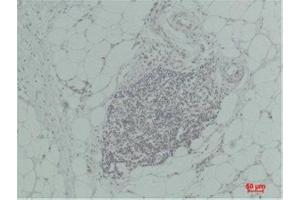 Immunohistochemistry (IHC) analysis of paraffin-embedded Human Breast Carcinoma using TNF a Rabbit Polyclonal Antibody diluted at 1:200. (TNF alpha anticorps)