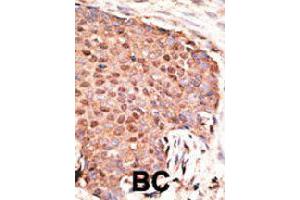 Formalin-fixed and paraffin-embedded human cancer tissue reacted with ZMIZ1 polyclonal antibody  , which was peroxidase-conjugated to the secondary antibody, followed by AEC staining. (ZMIZ1 anticorps  (C-Term))