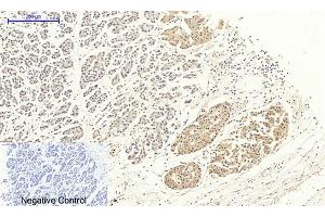 Immunohistochemical analysis of paraffin-embedded human stomach cancer tissue. (Dynamin 1-Like anticorps)