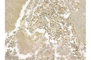 ABIN6261019 and ABIN6273216 at 1/100 staining human prostate carcinoma by IHC-P. (CRAT anticorps  (N-Term))
