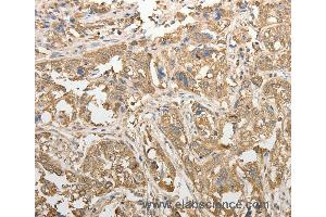 Immunohistochemistry of Human esophagus cancer using ADHFE1 Polyclonal Antibody at dilution of 1:50 (ADHFE1 anticorps)