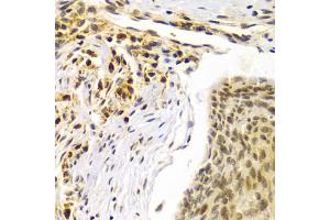 Immunohistochemistry of paraffin-embedded human esophageal cancer using SMARCE1 Antibody (ABIN5973097) at dilution of 1/100 (40x lens). (SMARCE1 anticorps)