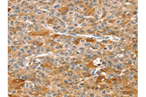 The image on the left is immunohistochemistry of paraffin-embedded Human liver cancer tissue using ABIN7129263(DSTYK Antibody) at dilution 1/25, on the right is treated with fusion protein. (DSTYK anticorps)