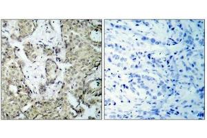 Immunohistochemical analysis of paraffin-embedded human breast carcinoma tissue using MKK3(Phospho-Ser189) Antibody(left) or the same antibody preincubated with blocking peptide(right).