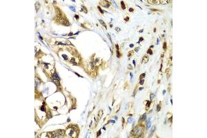 Immunohistochemistry of paraffin-embedded human liver cancer using TMOD4 antibody (ABIN5974100) at dilution of 1/100 (40x lens). (Tropomodulin 4 anticorps)