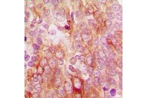 Immunohistochemical analysis of MCT12 staining in human breast cancer formalin fixed paraffin embedded tissue section.
