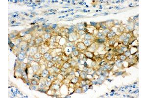 Anti- SQSTM1 Picoband antibody,IHC(P) IHC(P): Human Lung Cancer Tissue