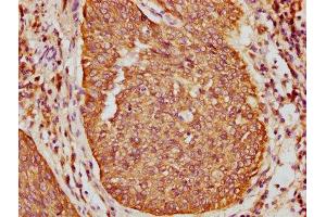 IHC image of ABIN7157388 diluted at 1:400 and staining in paraffin-embedded human cervical cancer performed on a Leica BondTM system.