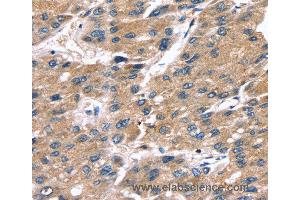 Immunohistochemistry of Human liver cancer using SRGN Polyclonal Antibody at dilution of 1:25 (SRGN anticorps)