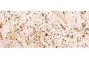 Immunohistochemistry of paraffin-embedded Human gastric cancer tissue using SGTA Polyclonal Antibody at dilution of 1:75(x200)