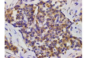 ABIN6267452 at 1/200 staining human liver cancer tissue sections by IHC-P.