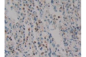 DAB staining on IHC-P; Samples: Human Lung cancer Tissue (HMGXB4 anticorps  (AA 264-540))