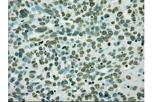 Immunohistochemical staining of paraffin-embedded Adenocarcinoma of breast tissue using anti-SILV mouse monoclonal antibody. (Melanoma gp100 anticorps)