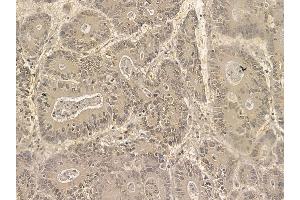 FAM114A2 Mouse Monoclonal Antibody at 1/100 staining human colorectal cancer by IHC-P. (FAM114A2 anticorps)