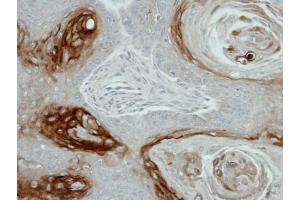 IHC-P Image Immunohistochemical analysis of paraffin-embedded Cal27 xenograft, using KLK7, antibody at 1:100 dilution.