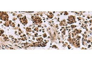 Immunohistochemistry of paraffin-embedded Human breast cancer tissue using SIK3 Polyclonal Antibody at dilution of 1:60(x200) (SIK3 anticorps)