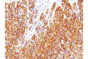 IHC testing of human melanoma stained with MART-1 antibody (M2-7C10). (MLANA anticorps)