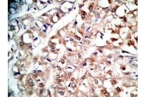 Human kidney cancer tissue was stained by rabbit Anti-BNP-45 (Mouse) Antiserum