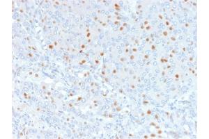 Formalin-fixed, paraffin-embedded human Bladder Carcinoma stained with Annexin A1 Mouse Monoclonal Antibody (6E4/3). (Annexin a1 anticorps)