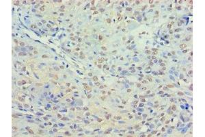 Immunohistochemistry of paraffin-embedded human breast cancer using ABIN7155310 at dilution of 1:100